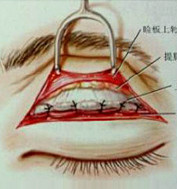 将上睑组织逐层切开