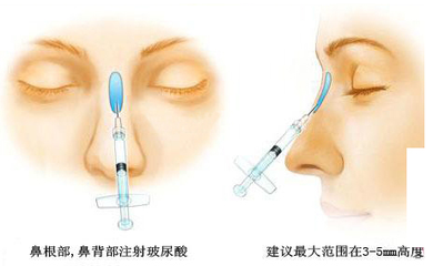 广州哪个机构隆鼻比较好呢