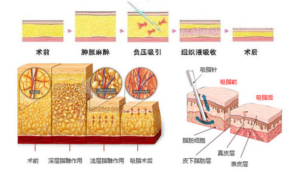 广州美莱吸脂减肥术后效果行不行呢