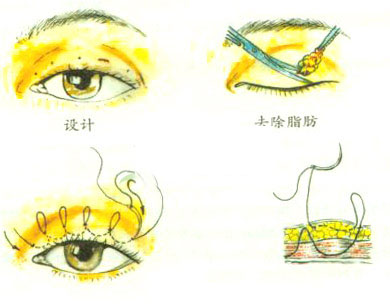 切双眼皮