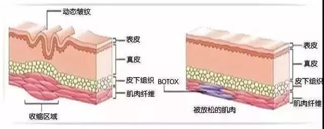 既能瘦脸,又能除皱的保妥适,会给每个