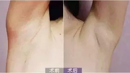 乳房下垂干瘪手术切皮图片